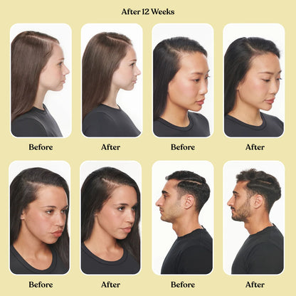 Lemme Grow: Crecimiento del cabello y anticaída* (sin biotina)